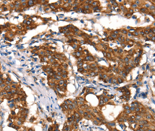 Immunohistochemistry of paraffin-embedded Human gastric cancer tissue using Cytochrome b Polyclonal Antibody at dilution 1:50