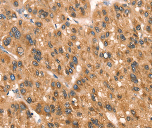 Immunohistochemistry of paraffin-embedded Human liver cancer tissue using DAP Polyclonal Antibody at dilution 1:40