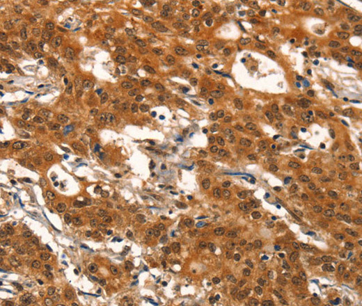 Immunohistochemistry of paraffin-embedded Human gasrtic cancer tissue using DEAF1 Polyclonal Antibody at dilution 1:40