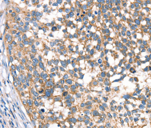 Immunohistochemistry of paraffin-embedded Human cervical cancer using DECR1 Polyclonal Antibody at dilution of 1:40