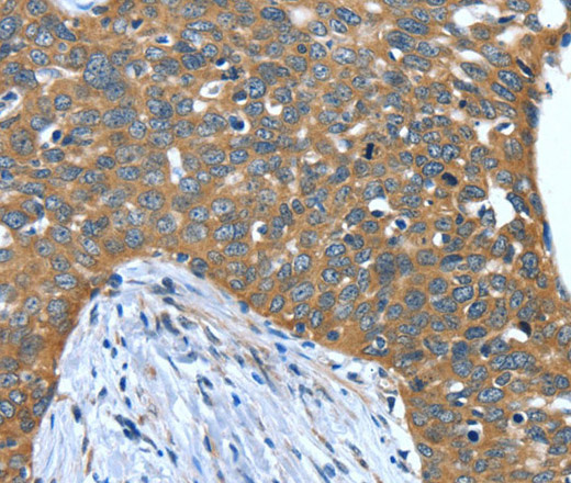 Immunohistochemistry of paraffin-embedded Human cervical cancer tissue using DTX1 Polyclonal Antibody at dilution 1:40