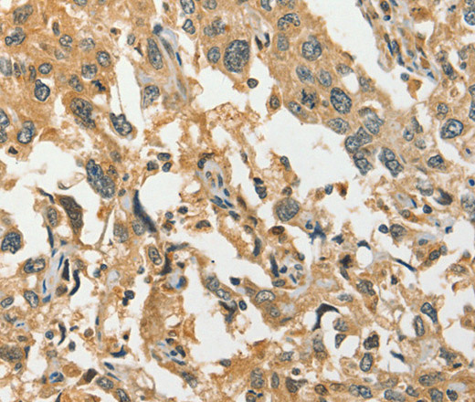 Immunohistochemistry of paraffin-embedded Human esophagus cancer tissue using DIRAS1 Polyclonal Antibody at dilution 1:30