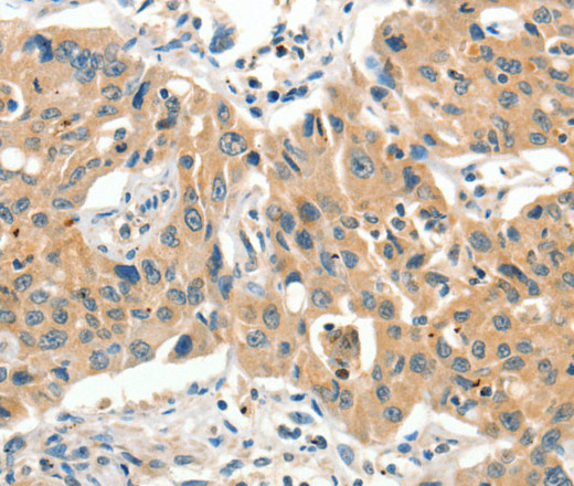 Immunohistochemistry of paraffin-embedded Human lung cancer tissue using SLC11A2 Polyclonal Antibody at dilution 1:65