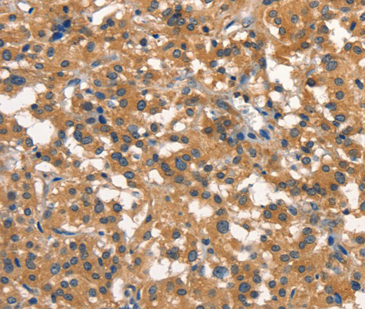 Immunohistochemistry of paraffin-embedded Human thyroid cancer using DNM2 Polyclonal Antibody at dilution of 1:40