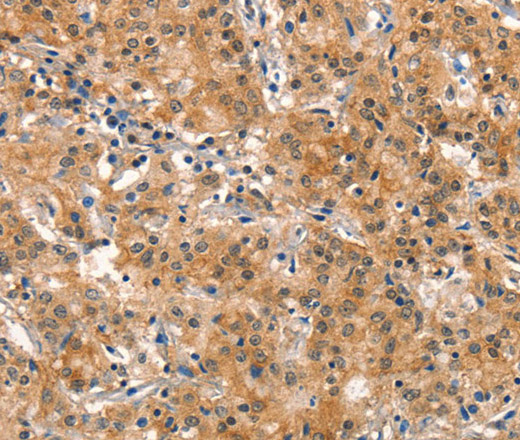 Immunohistochemistry of paraffin-embedded Human gastric cancer using DNM2 Polyclonal Antibody at dilution of 1:40