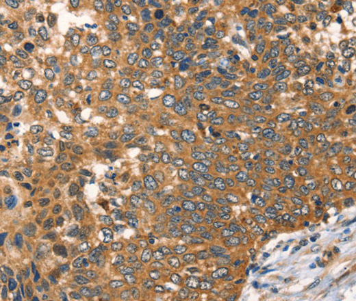 Immunohistochemistry of paraffin-embedded Human cervical cancer tissue using AGO1 Polyclonal Antibody at dilution 1:40