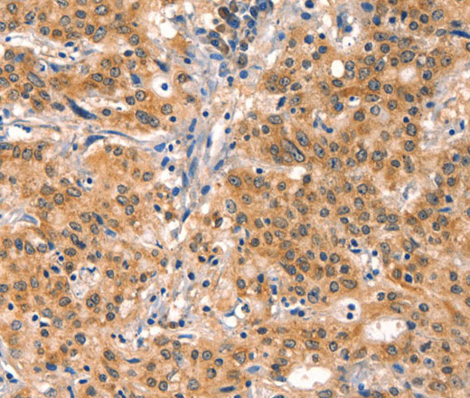 Immunohistochemistry of paraffin-embedded Human gastric cancer using EIF4G1 Polyclonal Antibody at dilution of 1:30