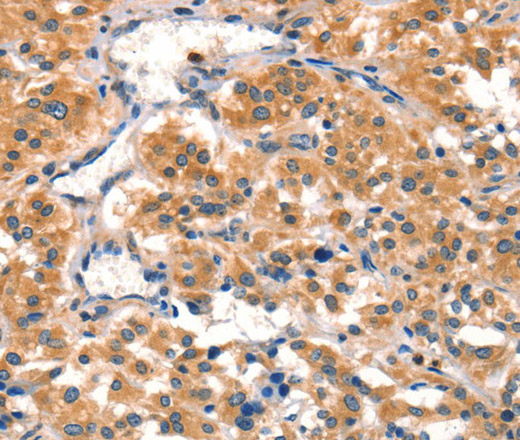 Immunohistochemistry of paraffin-embedded Human thyroid cancer using AIMP1 Polyclonal Antibody at dilution of 1:40