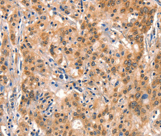 Immunohistochemistry of paraffin-embedded Human gastric cancer using AIMP1 Polyclonal Antibody at dilution of 1:40