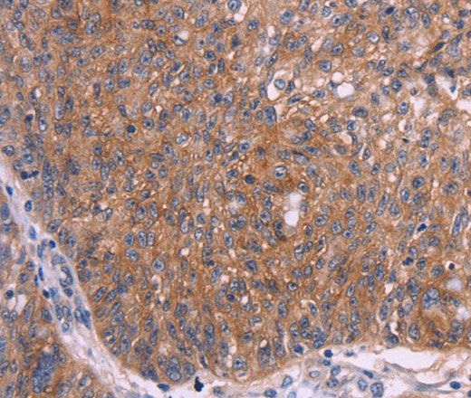 Immunohistochemistry of paraffin-embedded Human ovarian cancer tissue using EMP2 Polyclonal Antibody at dilution 1:30