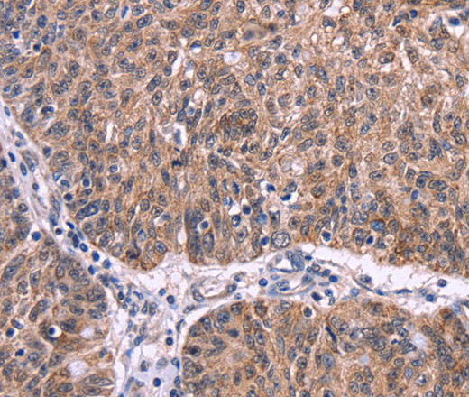 Immunohistochemistry of paraffin-embedded Human ovarian cancer tissue using Ephrin A5 Polyclonal Antibody at dilution 1:40