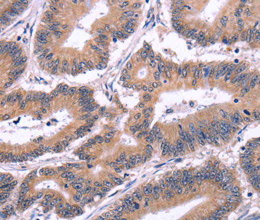 Immunohistochemistry of paraffin-embedded Human colon cancer tissue using Ephrin A5 Polyclonal Antibody at dilution 1:40