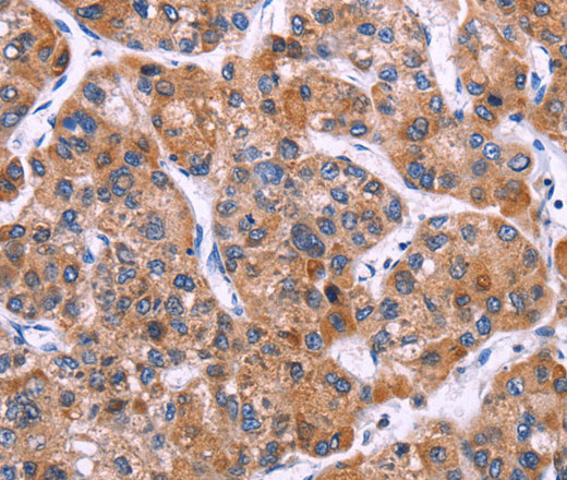 Immunohistochemistry of paraffin-embedded Human liver cancer tissue using MSMO1 Polyclonal Antibody at dilution 1:40