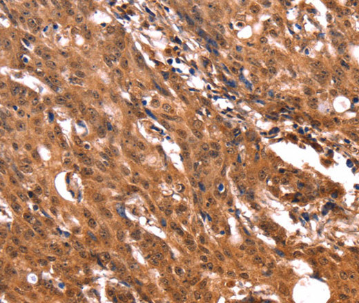 Immunohistochemistry of paraffin-embedded Human gastric cancer tissue using ERN2 Polyclonal Antibody at dilution 1:40