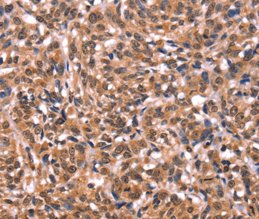 Immunohistochemistry of paraffin-embedded Human esophagus cancer tissue using ESRRB Polyclonal Antibody at dilution 1:40