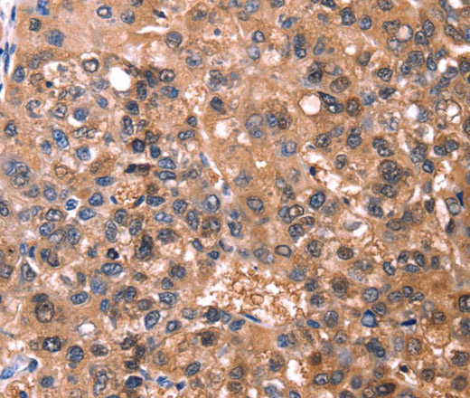 Immunohistochemistry of paraffin-embedded Human liver cancer tissue using ESRRB Polyclonal Antibody at dilution 1:40