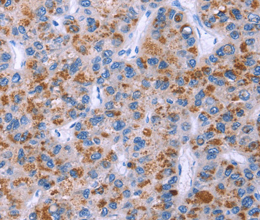 Immunohistochemistry of paraffin-embedded Human thyroid cancer tissue using ESPL1 Polyclonal Antibody at dilution 1:40