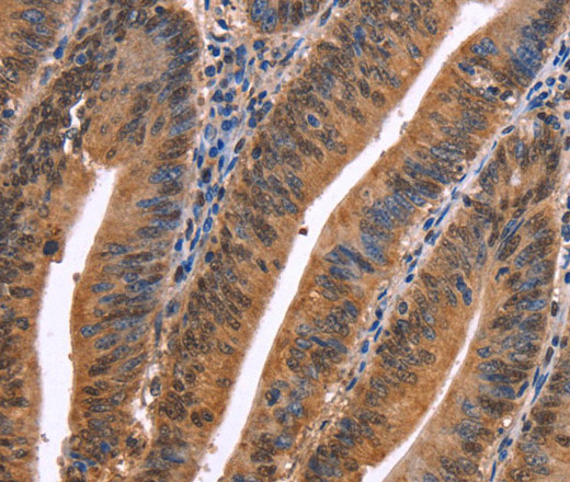 Immunohistochemistry of paraffin-embedded Human colon cancer using EVC2 Polyclonal Antibody at dilution of 1:40