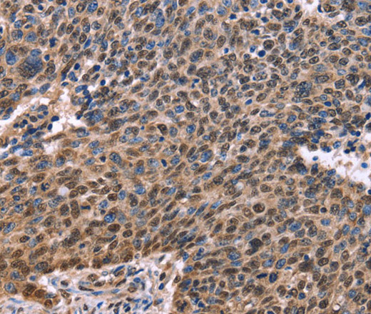 Immunohistochemistry of paraffin-embedded Human ovarian cancer using EVC2 Polyclonal Antibody at dilution of 1:40