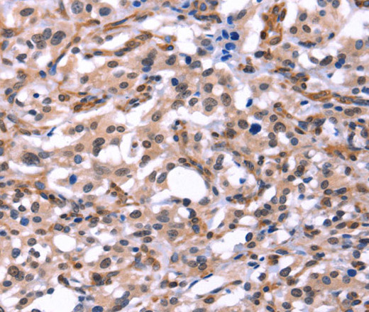 Immunohistochemistry of paraffin-embedded Human thyroid cancer tissue using GCG Polyclonal Antibody  at dilution 1:40