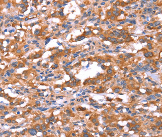 Immunohistochemistry of paraffin-embedded Human thyroid cancer tissue using FAM13B Polyclonal Antibody at dilution 1:30