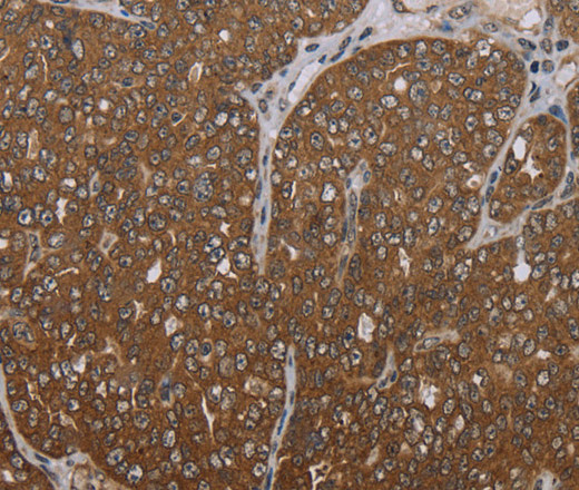 Immunohistochemistry of paraffin-embedded Human ovarian cancer tissue using FOLH1B Polyclonal Antibody at dilution 1:30