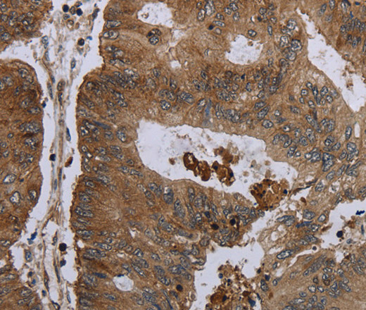 Immunohistochemistry of paraffin-embedded Human colon cancer tissue using FOLH1B Polyclonal Antibody at dilution 1:30