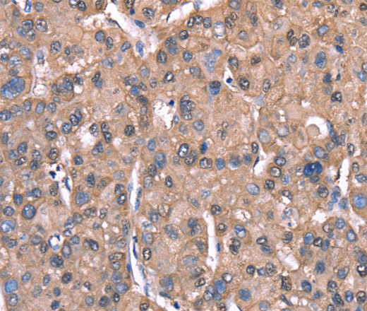 Immunohistochemistry of paraffin-embedded Human liver cancer tissue using SPAST Polyclonal Antibody at dilution 1:40