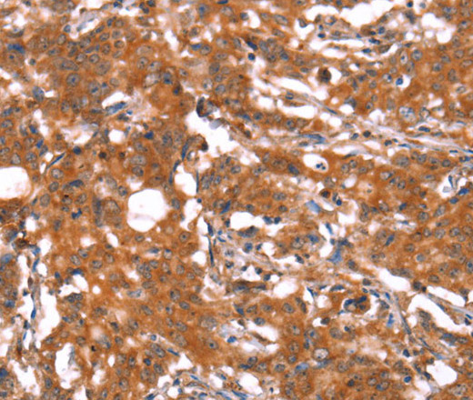 Immunohistochemistry of paraffin-embedded Human gastric cancer using FUT1 Polyclonal Antibody at dilution of 1:30