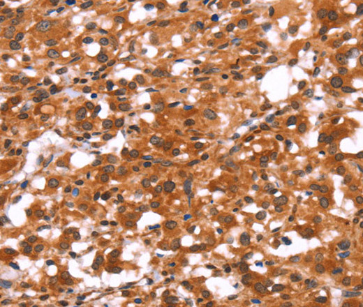 Immunohistochemistry of paraffin-embedded Human thyroid cancer using GABAA Receptor alpha1 Polyclonal Antibody at dilution of 1:30