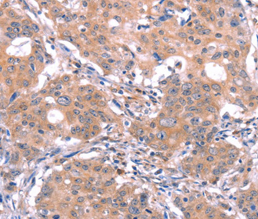 Immunohistochemistry of paraffin-embedded Human gastric cancer using GABAA Receptor alpha1 Polyclonal Antibody at dilution of 1:30