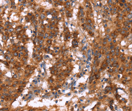 Immunohistochemistry of paraffin-embedded Human gastric cancer tissue using GAGE12I Polyclonal Antibody at dilution 1:30