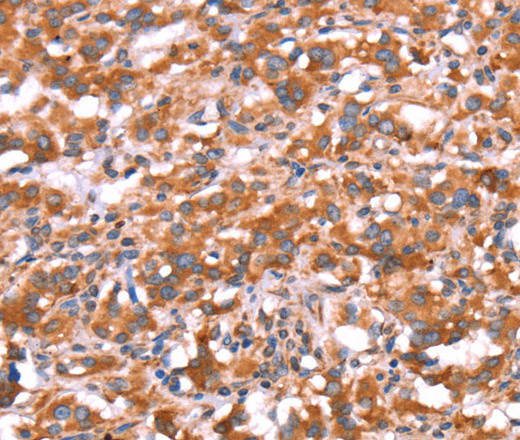 Immunohistochemistry of paraffin-embedded Human thyroid cancer tissue using GAS8 Polyclonal Antibody at dilution 1:30