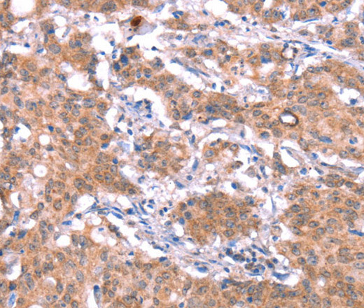 Immunohistochemistry of paraffin-embedded Human gastric cancer tissue using GAS8 Polyclonal Antibody at dilution 1:30