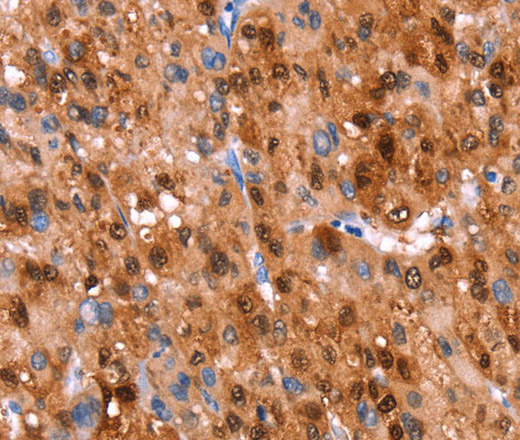 Immunohistochemistry of paraffin-embedded Human liver cancer using GH1 Polyclonal Antibody at dilution of 1:40