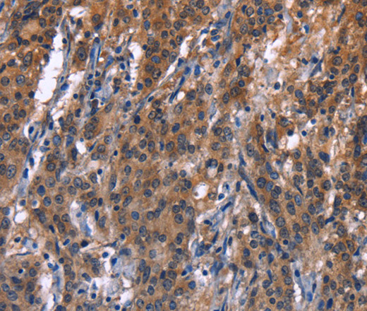 Immunohistochemistry of paraffin-embedded Human gastric cancer tissue using R3HCC1L Polyclonal Antibody at dilution 1:40