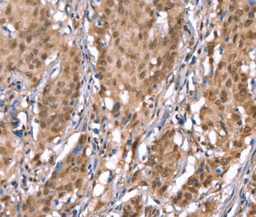 Immunohistochemistry of paraffin-embedded Human gasrtic cancer tissue using KCNJ6 Polyclonal Antibody at dilution 1:40