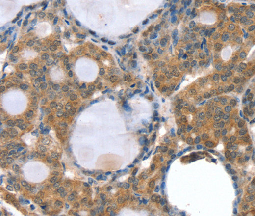 Immunohistochemistry of paraffin-embedded Human thyroid cancer using GNAT3 Polyclonal Antibody at dilution of 1:35