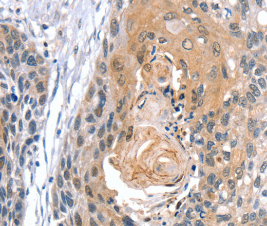 Immunohistochemistry of paraffin-embedded Human esophagus cancer using GNAT3 Polyclonal Antibody at dilution of 1:35