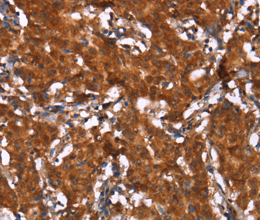 Immunohistochemistry of paraffin-embedded Human gasrtic cancer tissue using HCAR2 Polyclonal Antibody at dilution 1:40