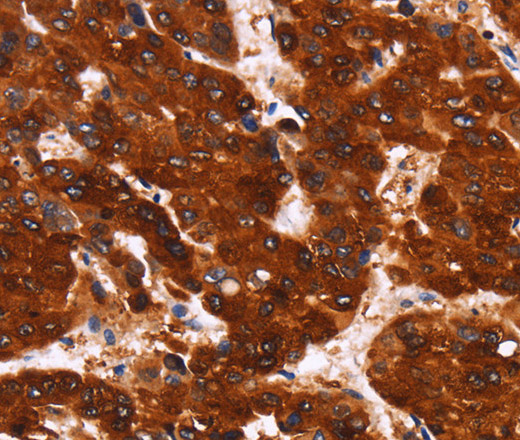 Immunohistochemistry of paraffin-embedded Human liver cancer using GPR124 Polyclonal Antibody at dilution of 1:40