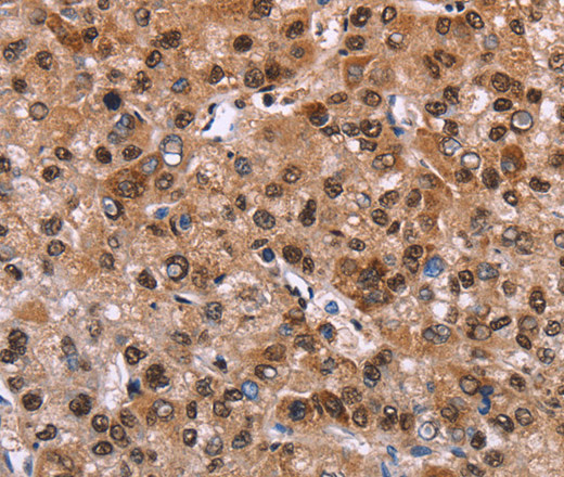 Immunohistochemistry of paraffin-embedded Human liver cancer tissue using GPR171 Polyclonal Antibody at dilution 1:40