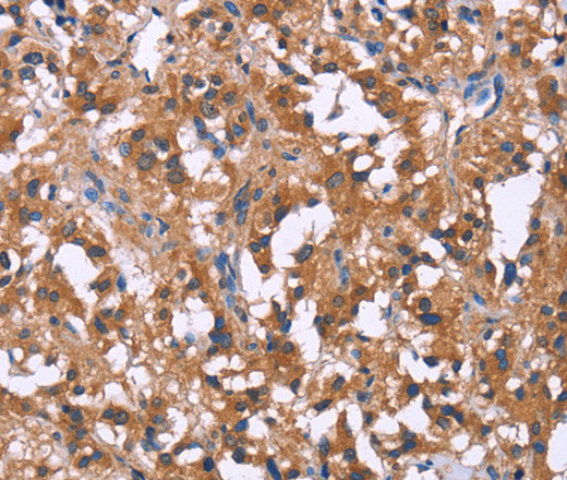 Immunohistochemistry of paraffin-embedded Human thyroid cancer tissue using GPR172B Polyclonal Antibody at dilution 1:40