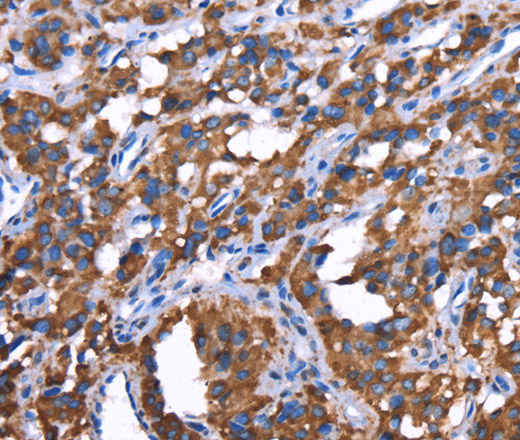 Immunohistochemistry of paraffin-embedded Human thyroid cancer tissue using GREB1 Polyclonal Antibody at dilution 1:50