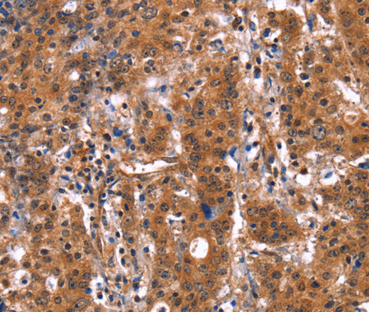 Immunohistochemistry of paraffin-embedded Human gastric cancer using GUK1 Polyclonal Antibody at dilution of 1:50