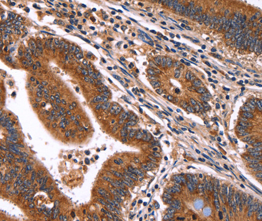 Immunohistochemistry of paraffin-embedded Human colon cancer tissue using HACE1 Polyclonal Antibody at dilution 1:50