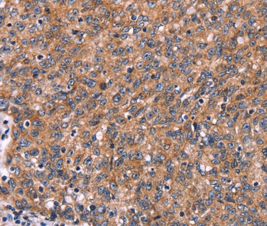 Immunohistochemistry of paraffin-embedded Human ovarian cancer tissue using HACE1 Polyclonal Antibody at dilution 1:50