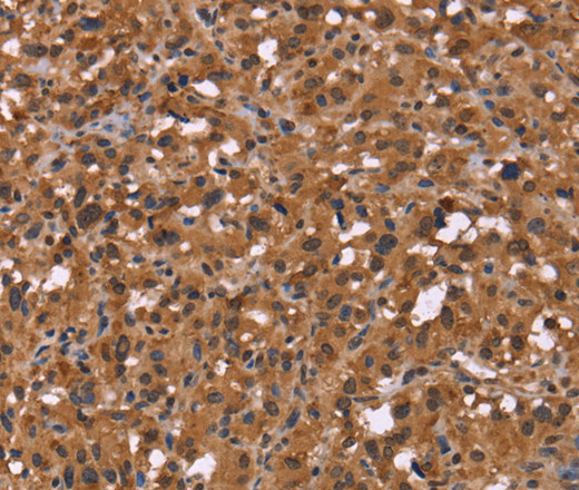 Immunohistochemistry of paraffin-embedded Human thyroid cancer using HDLBP Polyclonal Antibody at dilution of 1:50