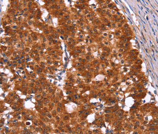 Immunohistochemistry of paraffin-embedded Human gastic cancer using HINT1 Polyclonal Antibody at dilution of 1:50