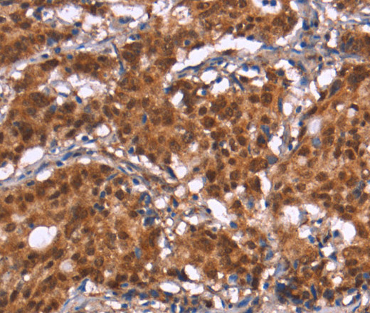 Immunohistochemistry of paraffin-embedded Human gastric cancer tissue using HIPK1 Polyclonal Antibody at dilution 1:30